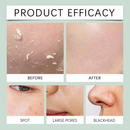 Gel Esfoliante Clareador para Remoção de Cravos - 50g (1/2 peças)